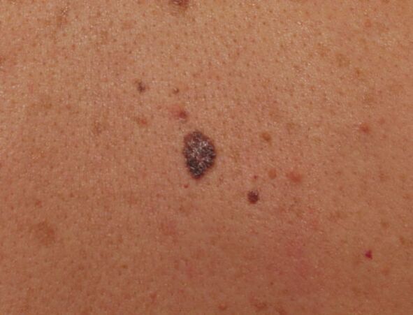 papilloma on the neck